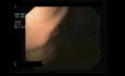 Gastric Fundal Varices