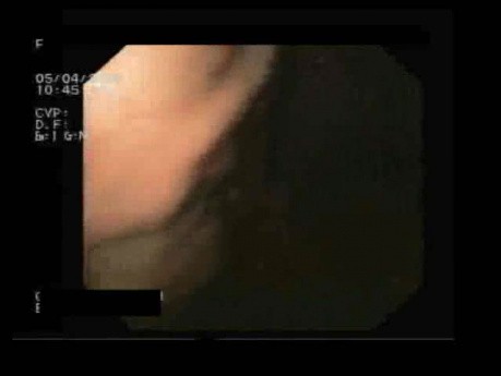 Gastric Fundal Varices