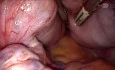 Handheld Robotic Arm Assisted Vaginal Hysterectomy