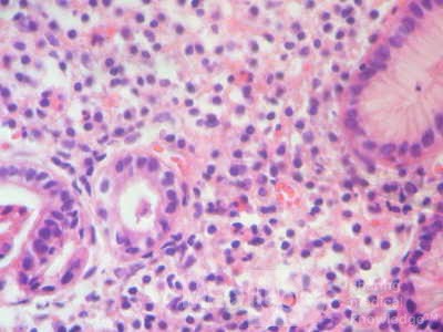 Eosinophilic Gastritis (6 of 7)