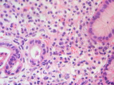 Eosinophilic Gastritis (6 of 7)