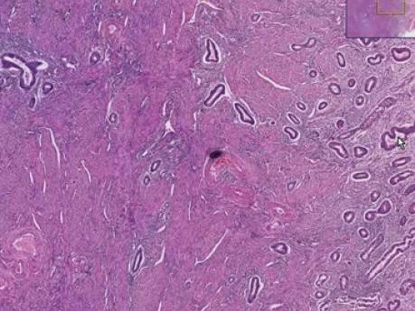 Adenomyosis