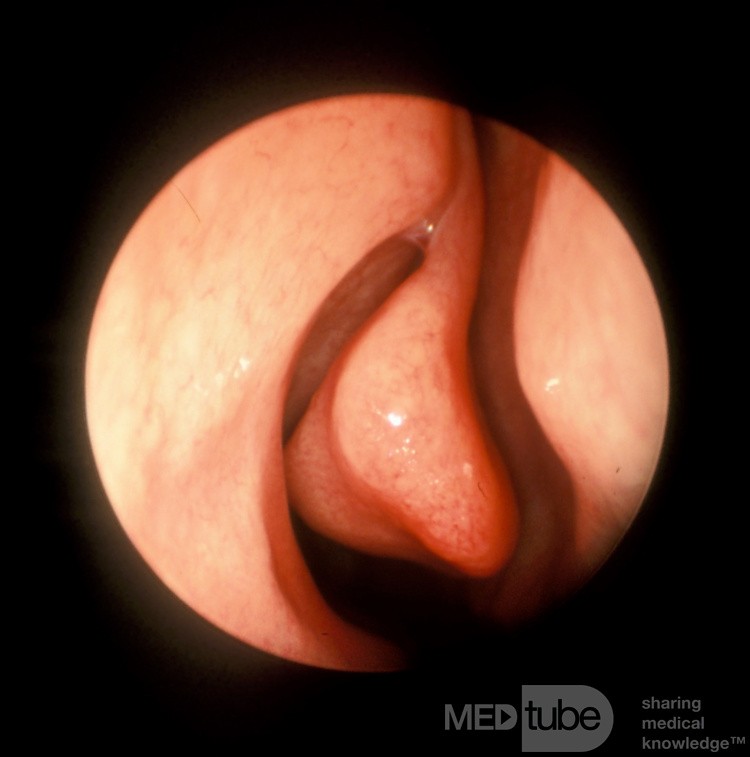 Paradoxically Bent Aerated Middle Turbinate [ConchaBullosa]