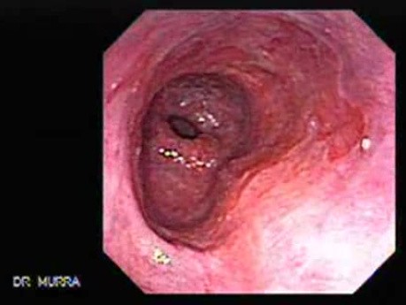 Barrett's Esophagus of long segment (15 of 24)