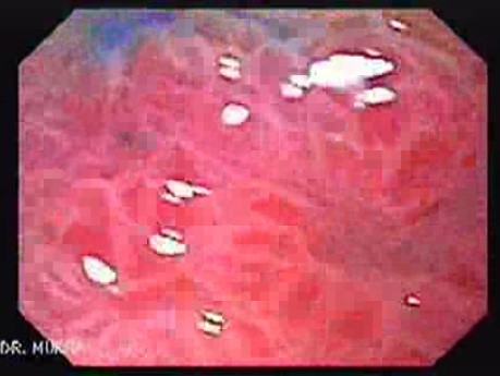 Pre - Pyloric Ulcer - Endoscopy (4 of 9)