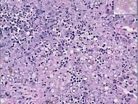 Blastomycosis