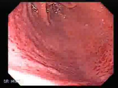 Acute Gastritis (Pangastritis) (7 of 10)