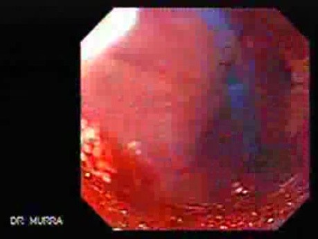 Esophageal Achalasia - Pneumatic Balloon Dilation, Video nr 2