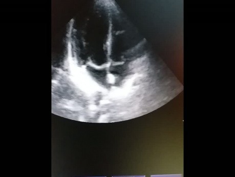 Interatrial Septal Lipomateous Hypertrophy