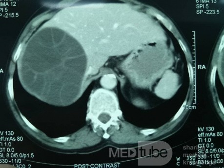 Liver Hydatid Cyst