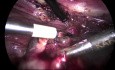 Laparoscopic Surgery of Right Ovarian Cyst - Salpingoophorectomy