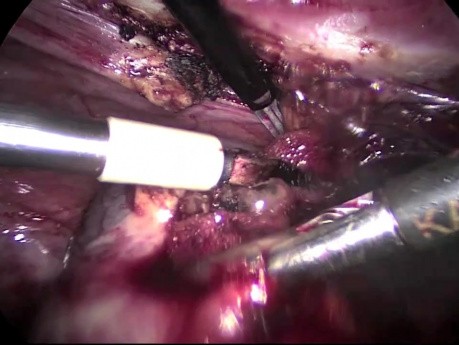 Laparoscopic Surgery of Right Ovarian Cyst - Salpingoophorectomy