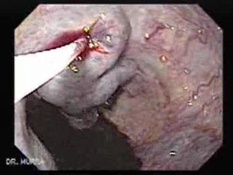 Severe Variceal Bleeding _ Beginning of the Sclerotherapy