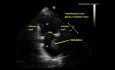 An Interesting  Echocardiography Case Apical 2 Chamber View