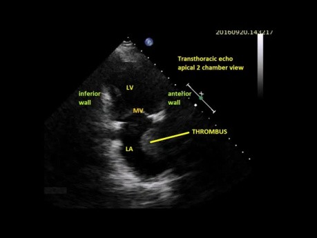 An Interesting  Echocardiography Case Apical 2 Chamber View