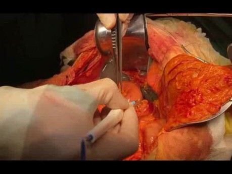 Pancreaticojejunal Anastomosis