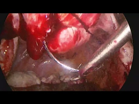 Multiple Uterine Fibroid (20) Removal to Save Uterus