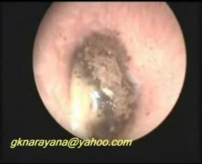 Fungal Ear Infection (Otomycosis)