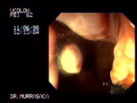 Status Post Rubber Band Ligation (2 of 3)