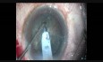 Uneventful Surgery in Hard Cataract Using Oval Rhexis