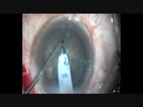 Uneventful Surgery in Hard Cataract Using Oval Rhexis