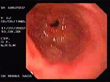 Gastric Ulcers and Erosions