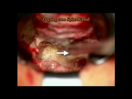 Stenosis of the Lumbar Spine