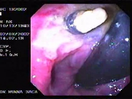 Status Post Rubber Band Treatment for Internal Hemorrhoids