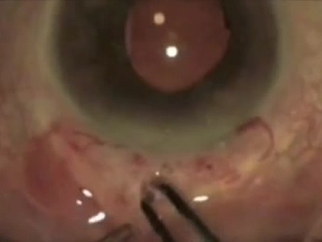 Atwal Balanced Approach - Posterior Chamber Glaucoma Filter