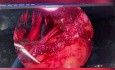 Rectal Shaving and Hysterectomy for Endometriosis 