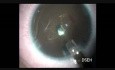 Secondary Intraocular Lens in a Child