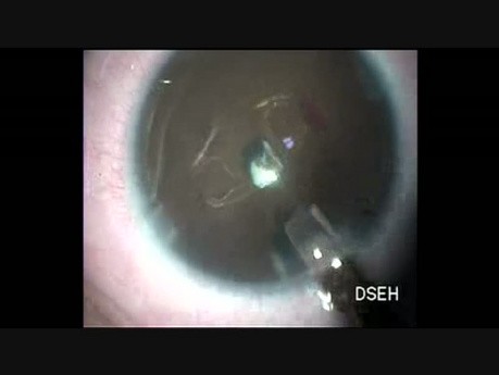 Secondary Intraocular Lens in a Child
