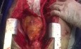 Direct Abdominal Visceral Revascularization for Type B Aortic Dissection