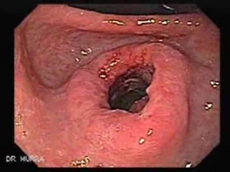 Gastric Cancer - Intestinal Metaplasia - Endoscopy (5 of 7)