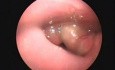 Epiglottitis In Scopy (OPD)