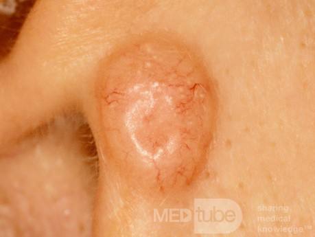 Basal Cell Carcinoma