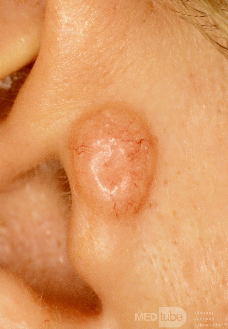 Basal Cell Carcinoma