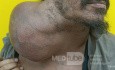 Huge Neck Swelling