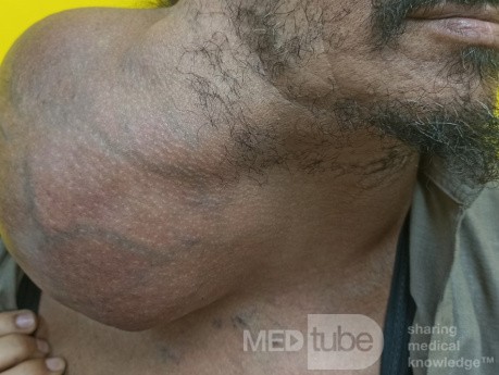 Huge Neck Swelling