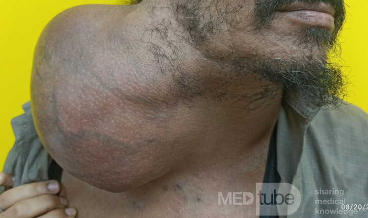 Huge Neck Swelling