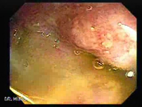 Severe case of Ischemic Colitis (6 of 19)
