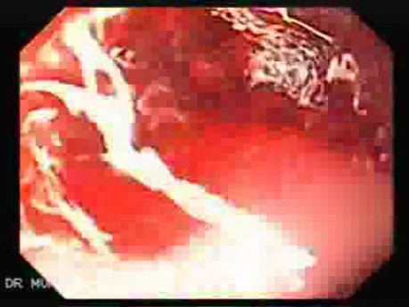 Barrett Adenocarcinoma - Therapeutic Endoscopy (4 of 7)