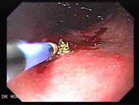 Severe Bleeding after Biopsies (2 of 7) - Argon Plasma Coagulator