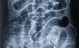 Straight Abdominal X-Ray of Intestinal Obstruction in a 80 Years Old Male 