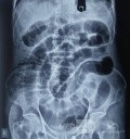 Straight Abdominal X-Ray of Intestinal Obstruction in a 80 Years Old Male 
