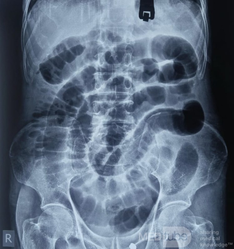 Straight Abdominal X-Ray of Intestinal Obstruction in a 80 Years Old Male 