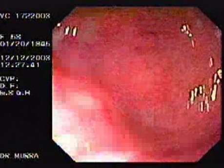 Unspecific Colitis due to Shigellosis (4 of 7)