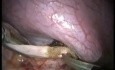Transabdominal Transdiaphragmatic Excision of Pericardial Cyst - Laparoscopy