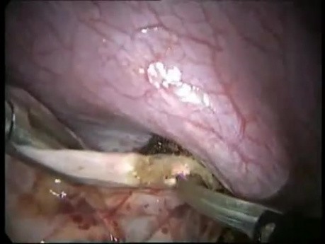 Transabdominal Transdiaphragmatic Excision of Pericardial Cyst - Laparoscopy