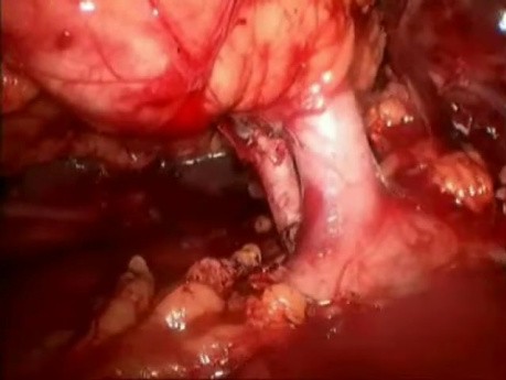 Donor Kidney Excision Via Vagina